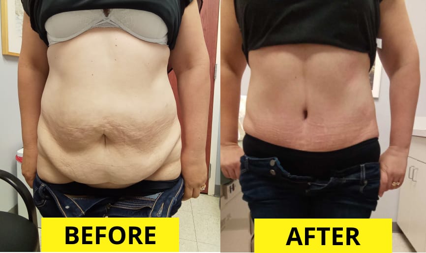 before and after a tummy tuck chicago