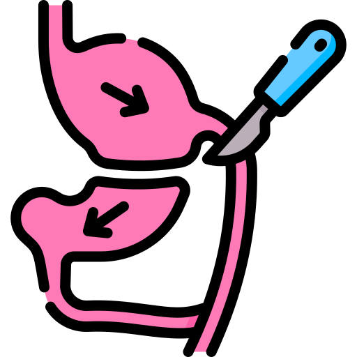 SIPS bariatric surgery illustration