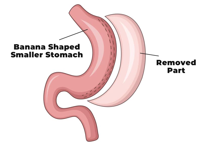 gastric sleve illustration