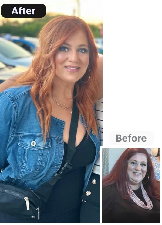 Before and After Weight Loss Surgery Chicago